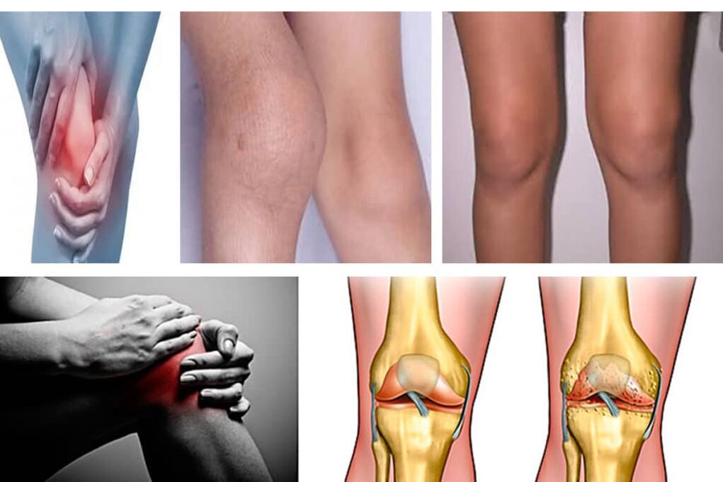 Các triệu chứng của bệnh viêm khớp đầu gối